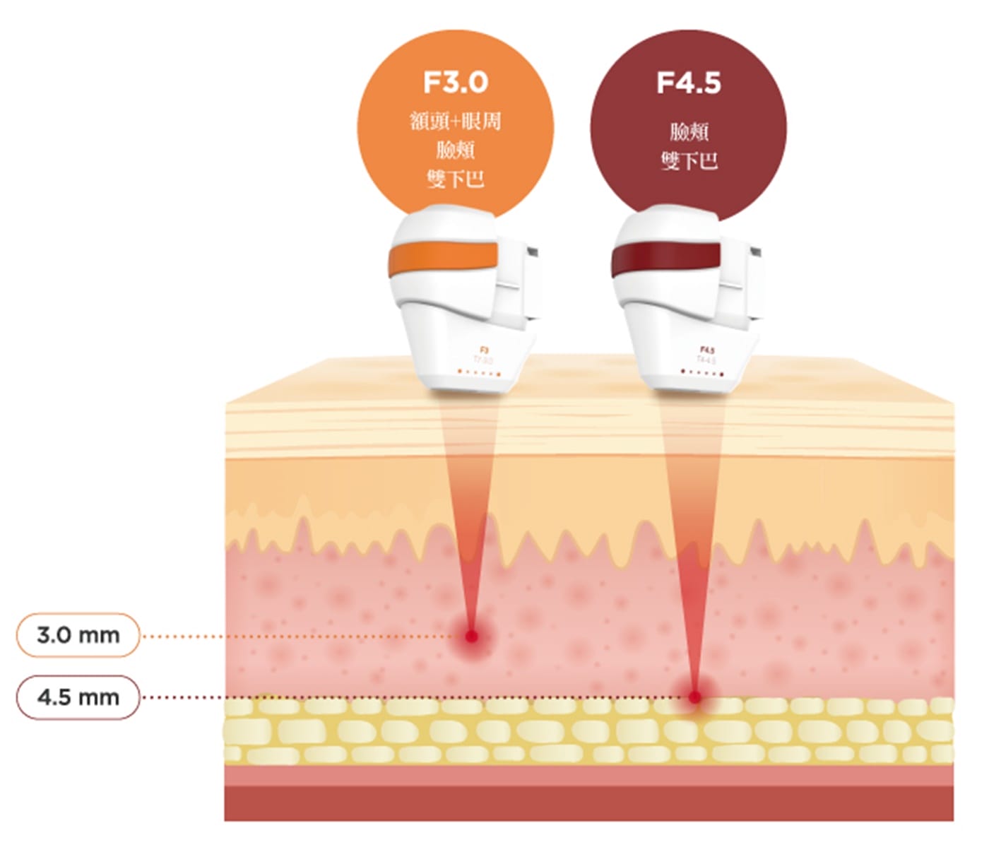 3.0mm 與 4.5mm 探頭深度示意圖