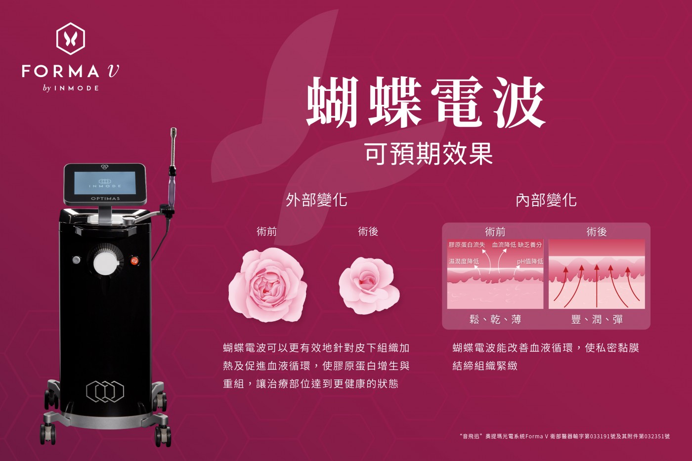 FORMA V蝴蝶電波的治療效果